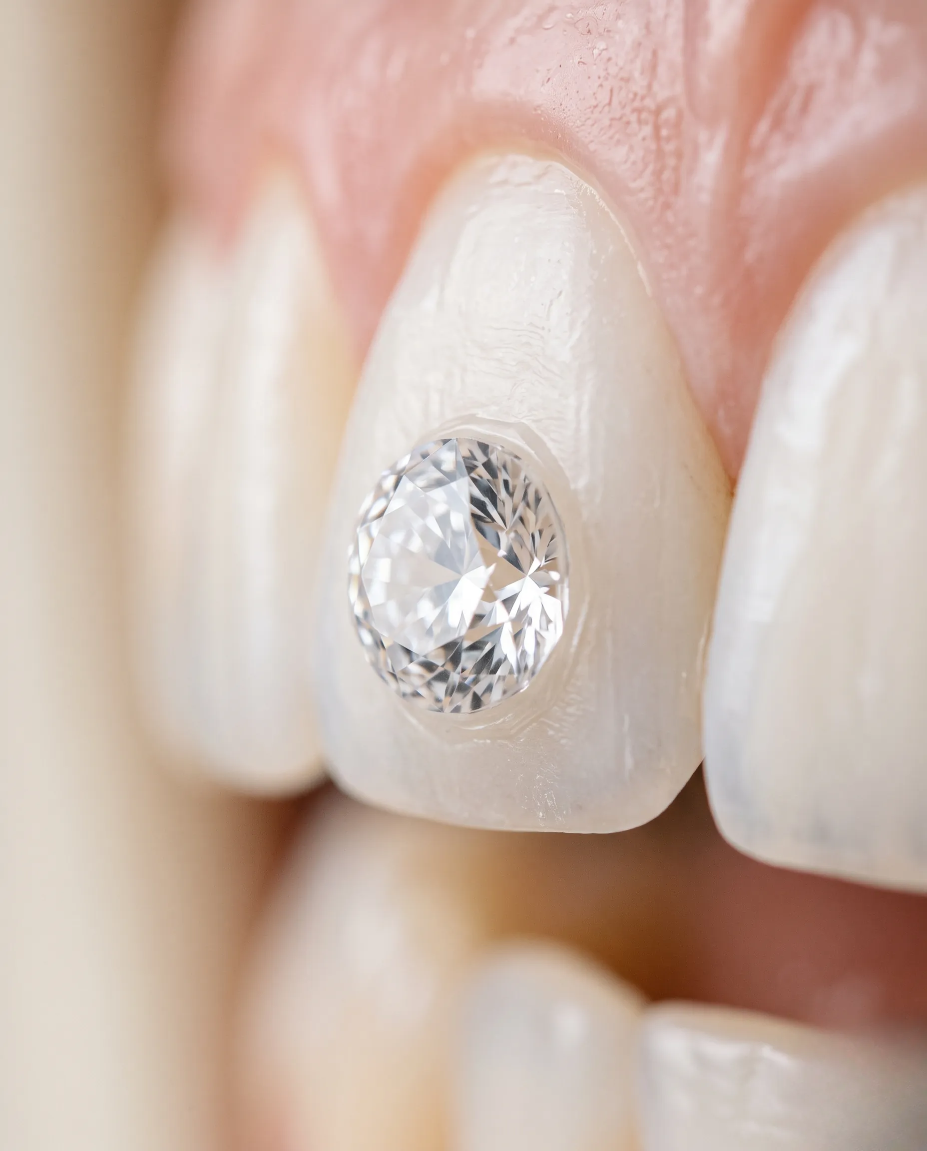 Gros plan macro d'un strass dentaire Swarovski sur une dent, mettant en valeur la précision de sa taille et sa pureté cristalline.